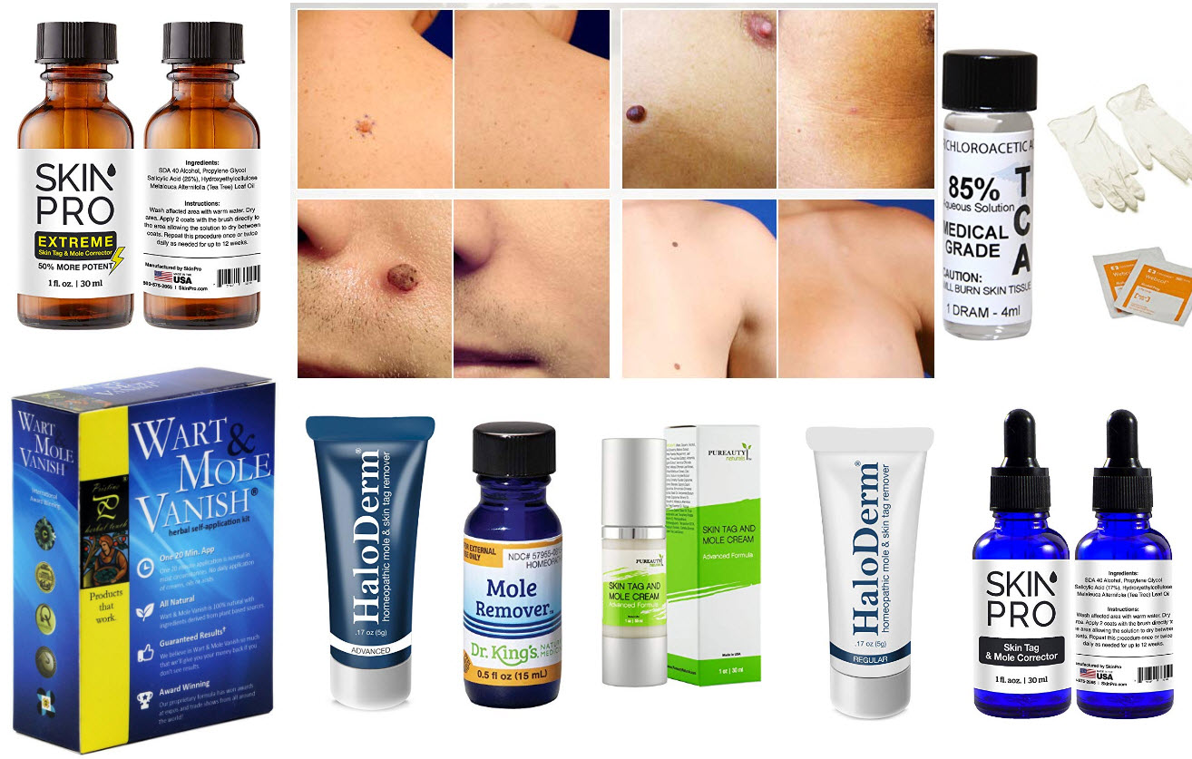 Which 10 Mole Removal Creams Are Best?