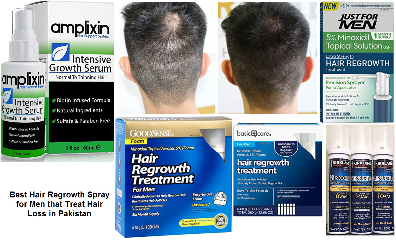 Best Hair Regrowth Spray For Men That Treat Hair Loss In Pakistan