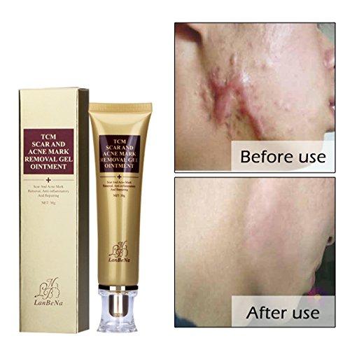 Shoppingexpress pk Amareu Acne Scar Removal Cream Skin Repair Face 